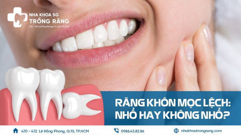 Răng khôn mọc lệch có nên nhổ