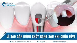 Vì sao cần đóng chốt răng sau khi chữa tủy
