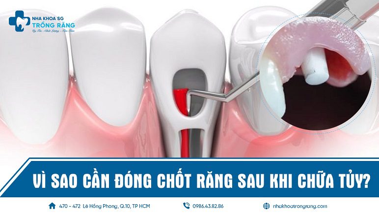 Vì sao cần đóng chốt răng sau khi chữa tủy
