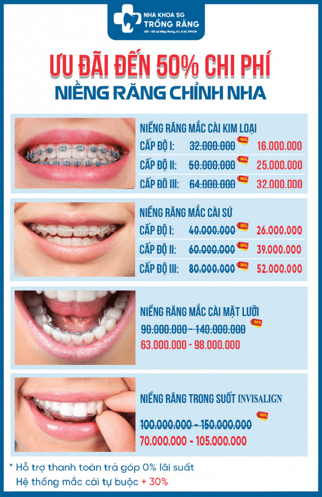 Bảng giá niềng răng