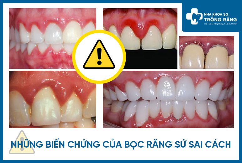 Biến chứng nghiêm trọng sau khi bọc răng sứ