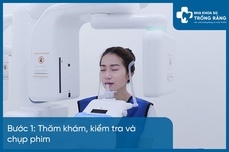 Bước 1 dán răng sứ veneer