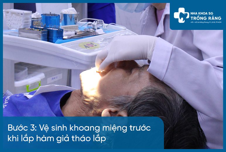 Bước 3 làm hàm răng giả tháo lắp