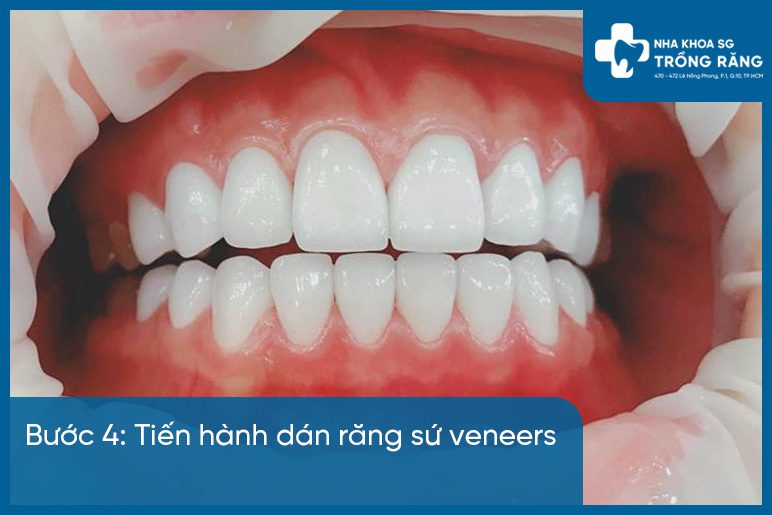 Bước 4 dán răng sứ veneer