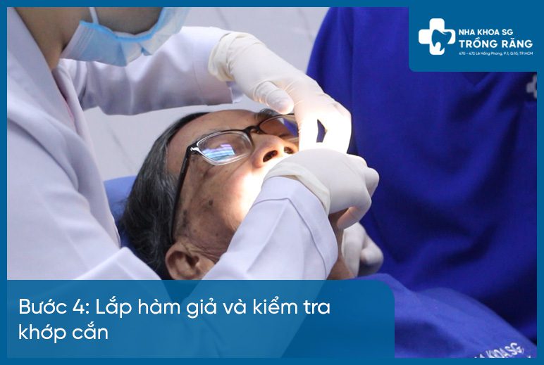 Bước 4 làm hàm răng giả tháo lắp