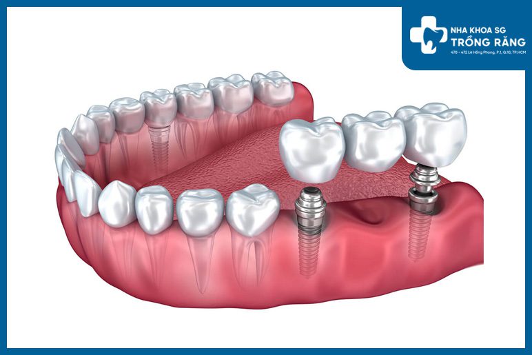 Cầu răng sứ trên Implant