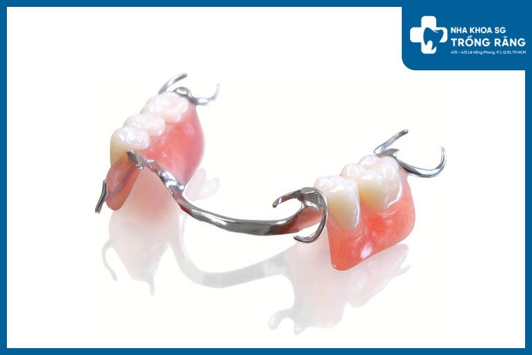 Hàm răng giả tháo lắp khung kim loại