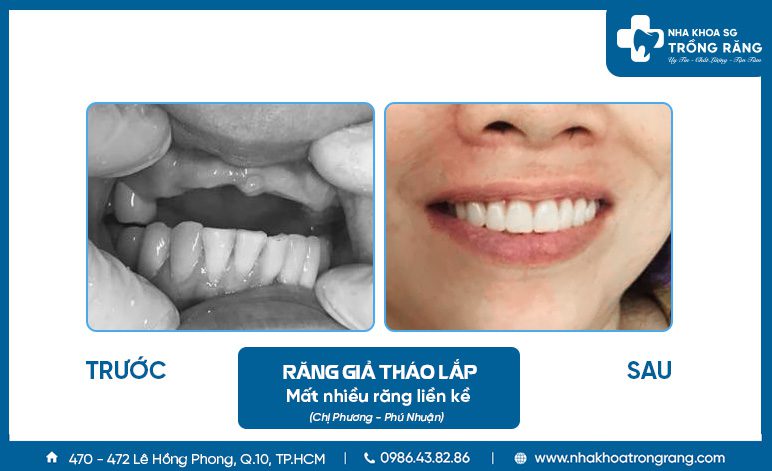 Khách hàng trồng răng giả tháo lắp toàn hàm trên