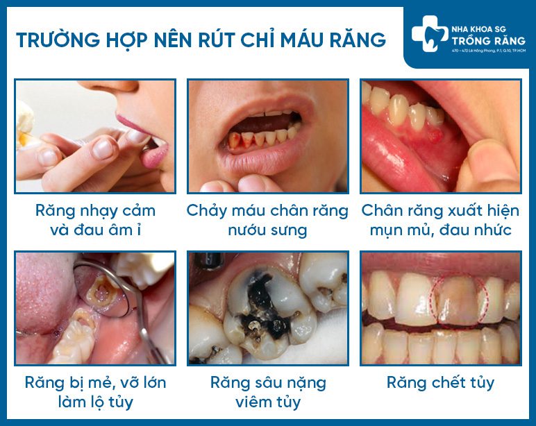 Khi nào nên rút chỉ máu răng