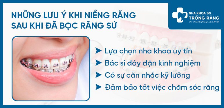 Lưu ý niềng răng khi răng đã bọc sứ