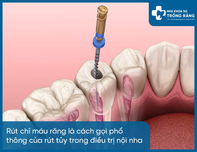 Mô phỏng rút chỉ máu răng