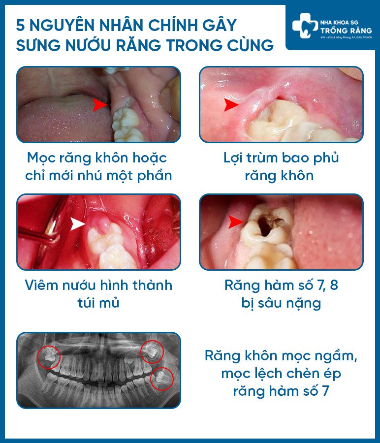 Nguyên nhân bị sưng nướu răng trong cùng