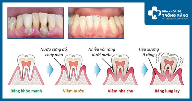 Nha chu làm răng lung lay