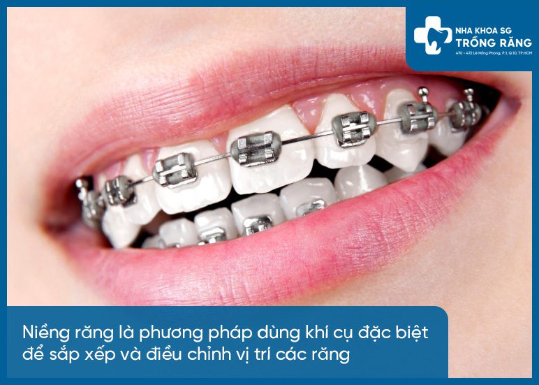 Phương pháp niềng răng