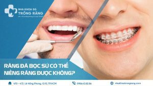 Răng đã bọc sứ có niềng được không
