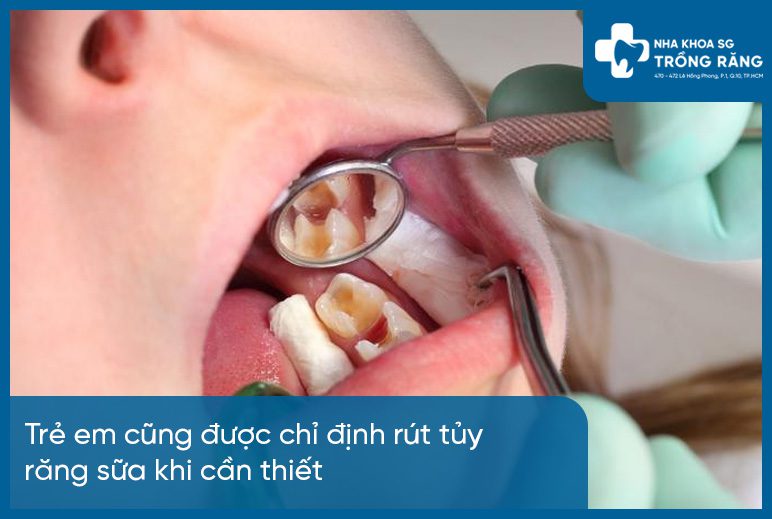 Rút chỉ máu răng trẻ em