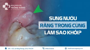 Sưng nướu răng trong cùng làm sao trị khỏi