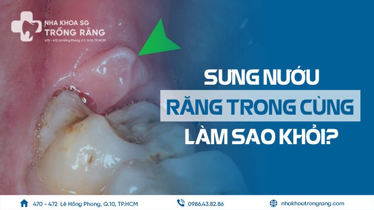 Sưng nướu răng trong cùng làm sao trị khỏi