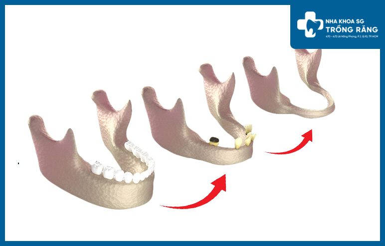 Tiêu xương hàm làm răng lung lay