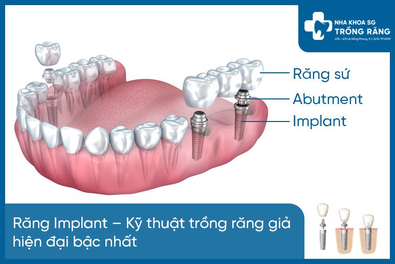 Các loại răng giả