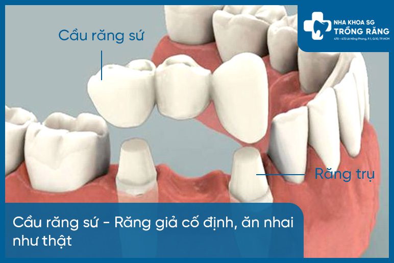 bắc cầu răng sứ giá bao nhiêu
