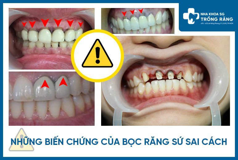 Viêm tủy do bọc răng sứ
