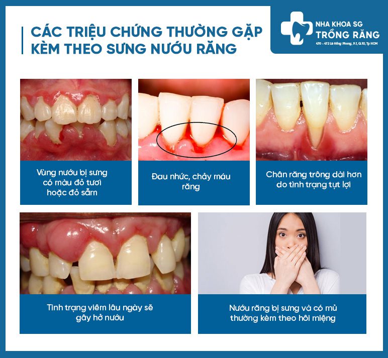 các triệu chứng thường gặp khi bị sưng nướu răng