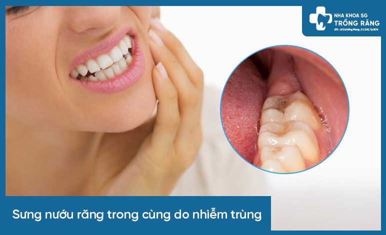 sưng nướu răng trong cùng do nhiễm trùng