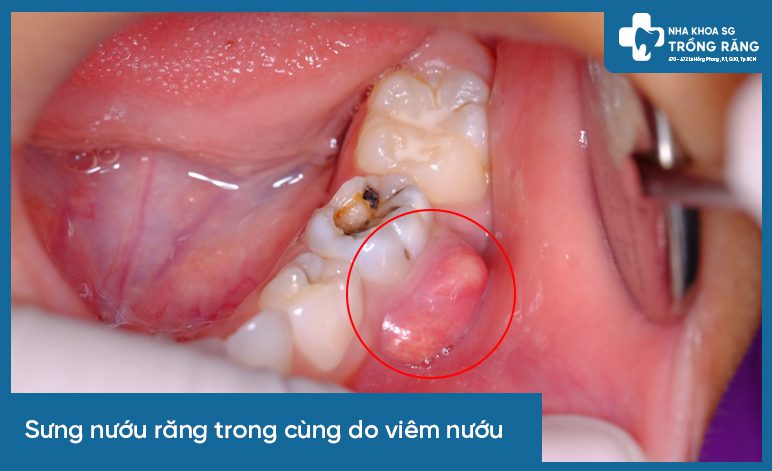 sưng nướu răng trong cùng do viêm nướu
