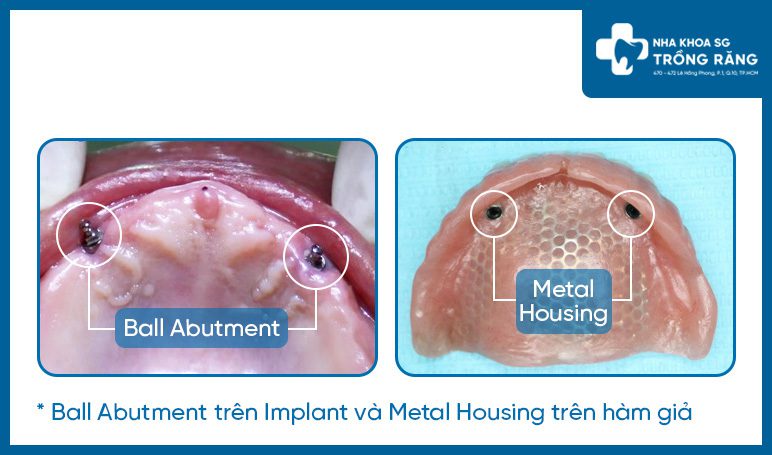 Ball Abutment Implant