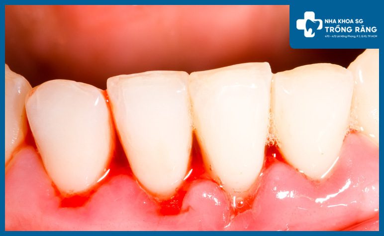 Bệnh răng miệng ở người lớn tuổi