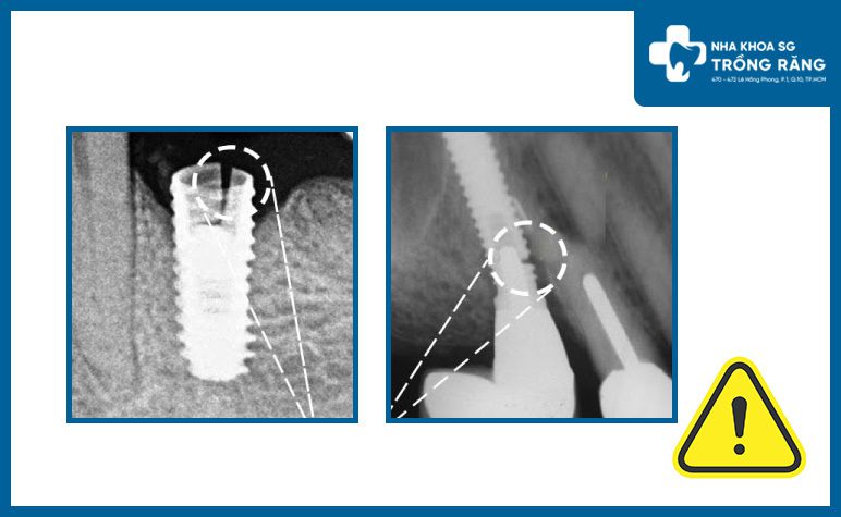 Biến chứng gãy implant