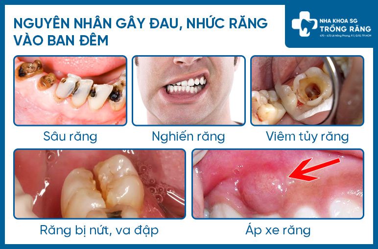 Các nguyên nhân gây đau nhức răng vào ban đêm Các nguyên nhân gây đau nhức răng vào ban đêm