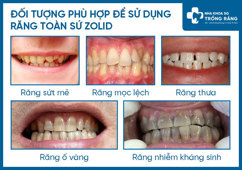 Các trường hợp nên trồng răng sứ Zolid