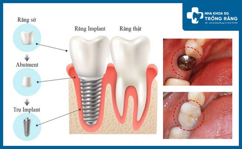 Cấu tạo răng implant cấy ghép