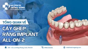 Cấy ghép implant có tốt không