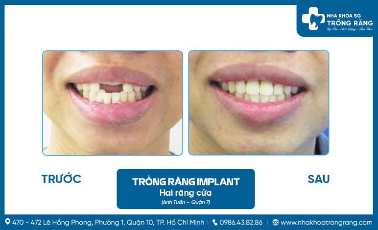 Cấy ghép implant răng cửa