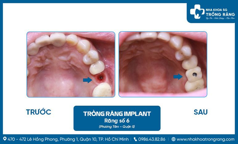 Cấy ghép implant răng hàm