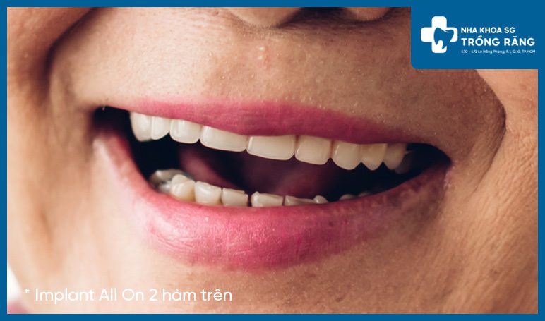 Cười sau khi cấy ghép implant