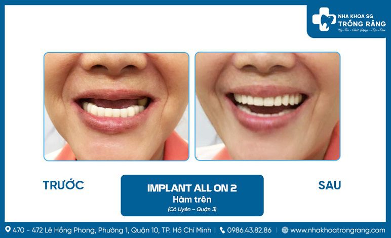 Hình ảnh cấy ghép implant all on 2