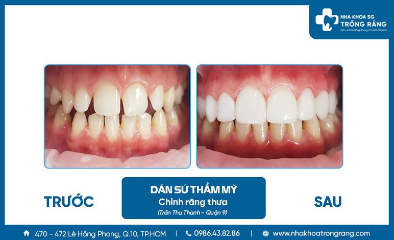 Hình ảnh dán sứ chỉnh thưa