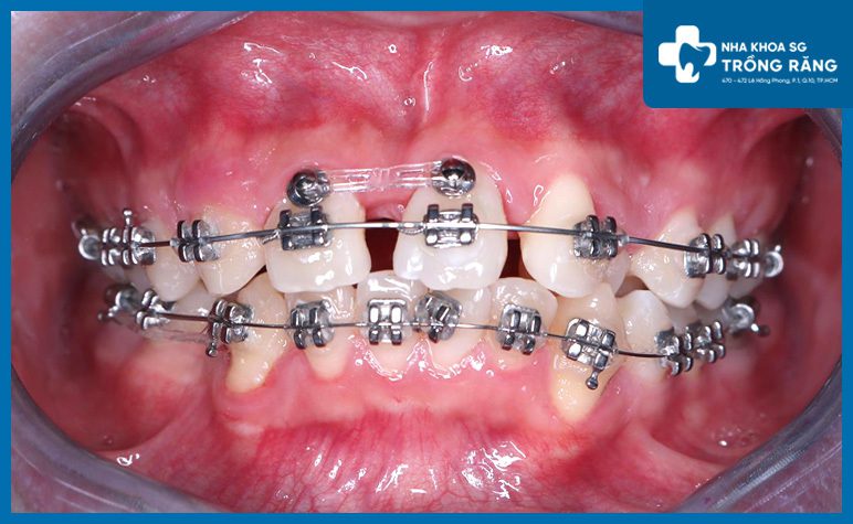 Hình ảnh niềng răng thưa
