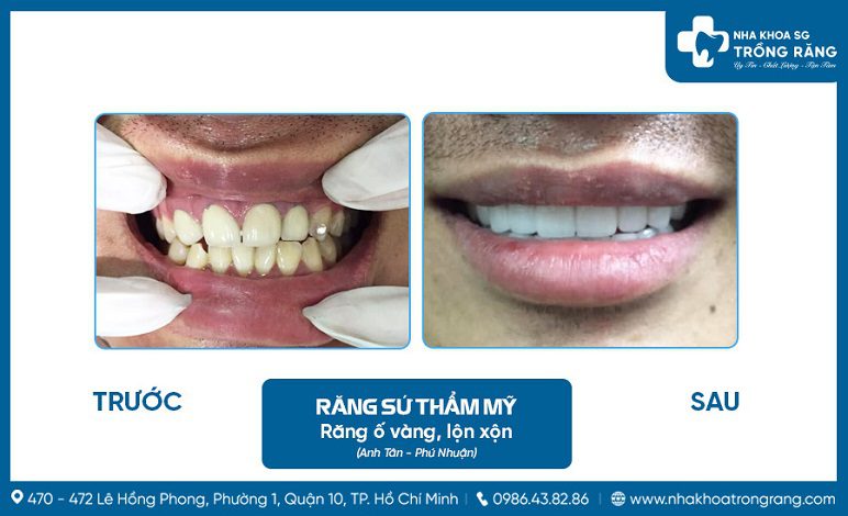 Hình ảnh trồng răng sứ Zolid