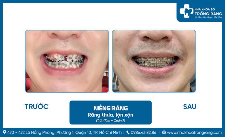 Kết quả niềng răng thưa