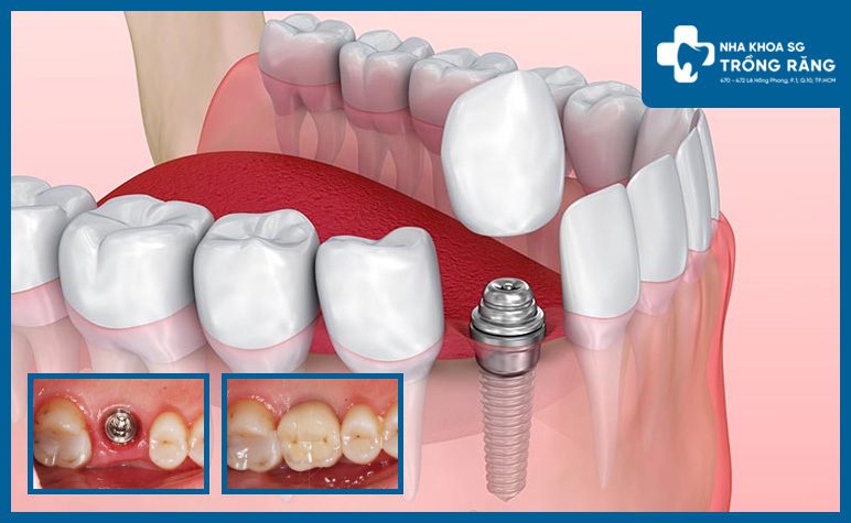 Minh họa trồng răng implant ở người lớn tuổi
