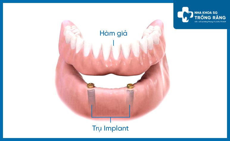 Mô phỏng cấy ghép implant all on 2