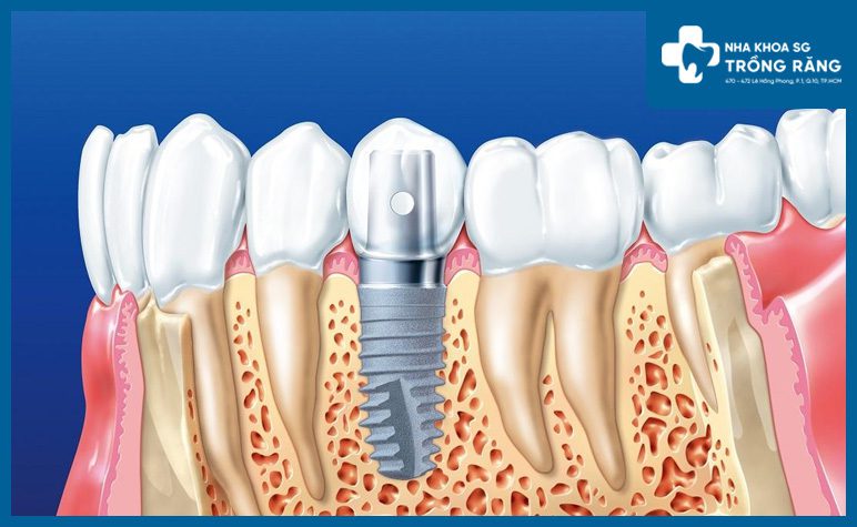 Mô phỏng cấy ghép răng implant