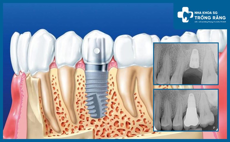 Mô phỏng trồng implant vào xương hàm
