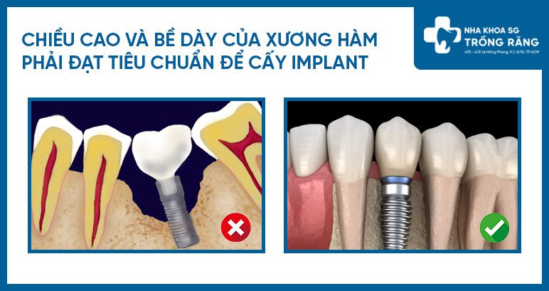 Mức độ xương phù hợp khi cấy implant