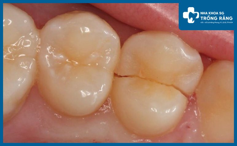 Răng bị nứt gay nhức răng vào ban đêm Răng bị nứt gay nhức răng vào ban đêm